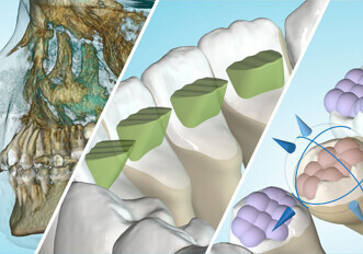 Ormco – Spark clear aligners release 12