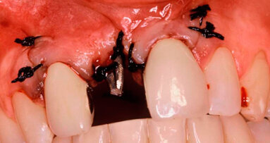 La tecnica del carico immediato con impianti one-piece stabilizzati con ago sincristallizzato: case report