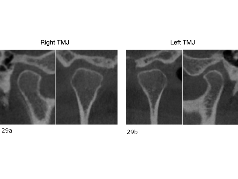 Figs. 29a–d: Pretreatment CBCT images showing the stability of both temporomandibular joints. Right, (a) sagittal and (b) coronal views. Left, (c) coronal and (d) sagittal views.