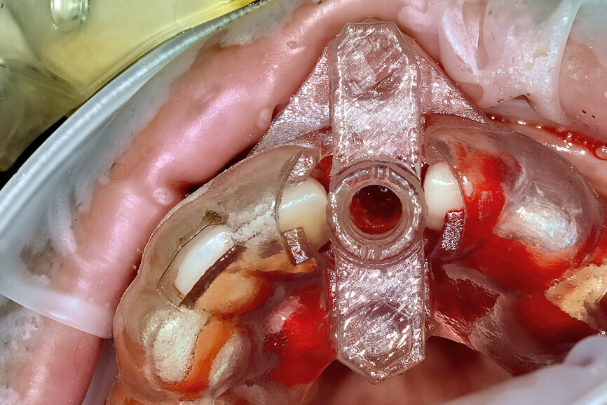 Fig. 22a: The final insert was designed to receive the guided sleeveless drills for accurate osteotomy preparation (a). The osteotomy was prepared to avoid
proximity to the remaining root fragment while leaving sufficient restorative space as previously planned (b).