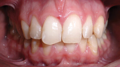 Il trattamento ClearCorrect® per l’accavallamento e la costrizione delle arcate dentali