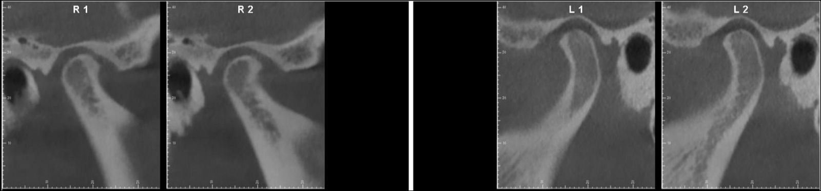Figs. 41a–d: CBCT images of both temporomandibular joints after splint therapy (sagittal views). (a & b) Right. (c & d) Left.