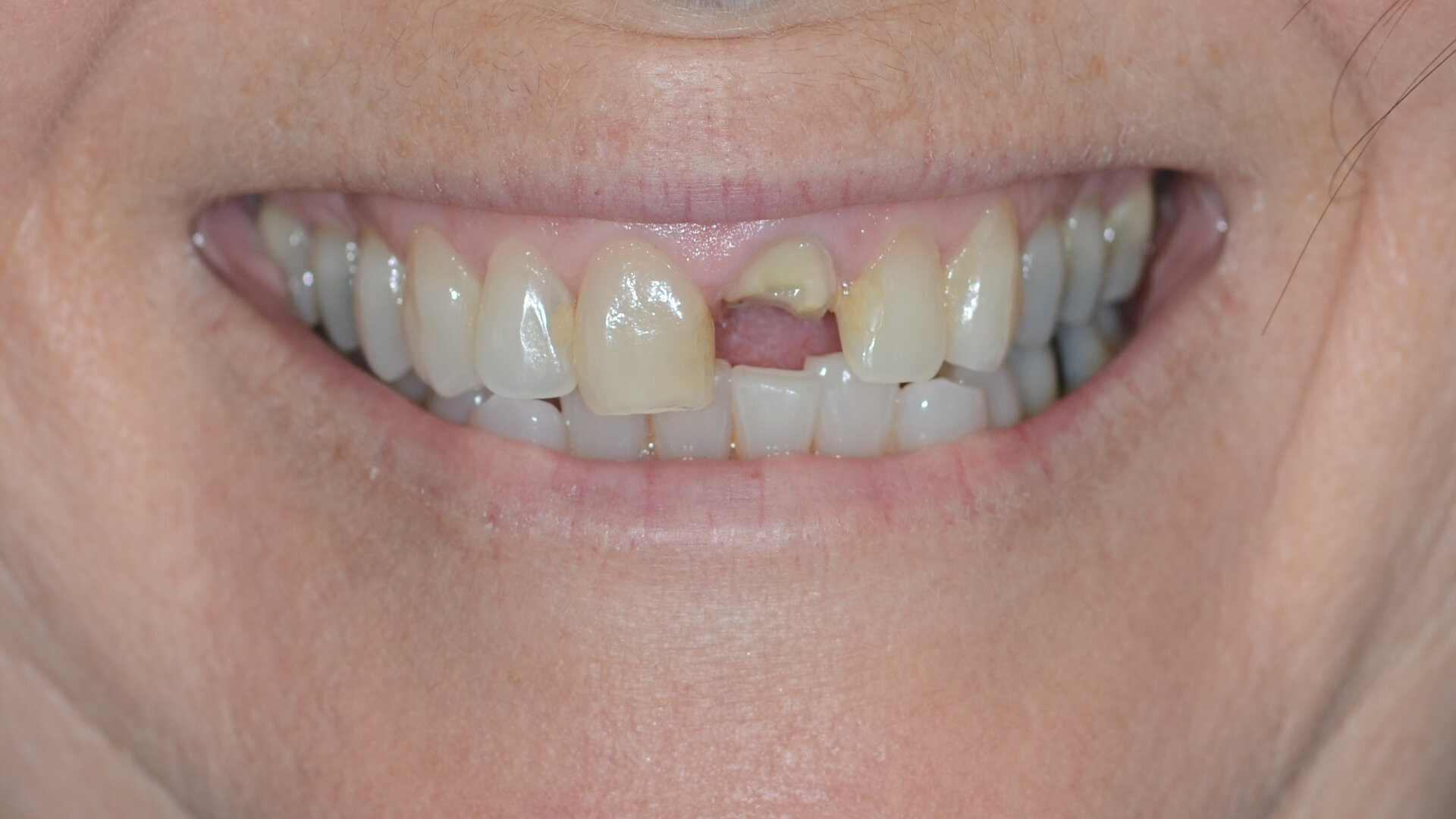 Immediate implant placement and restoration in fractured incisor with external root resorption