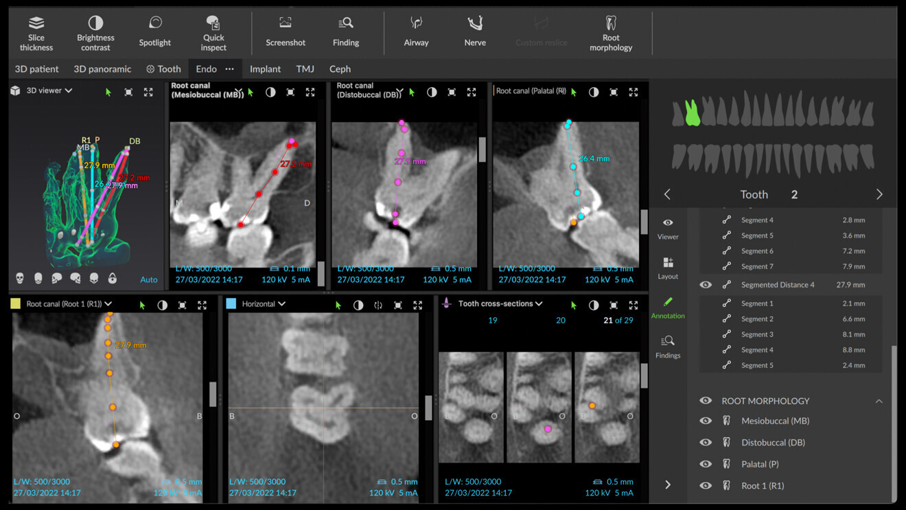 Fig. 3: Endodontic mode in DTX Studio Clinic tracing the anatomy of the canals and providing an approximate working length in different colours for each canal. Four separate roots are shown.