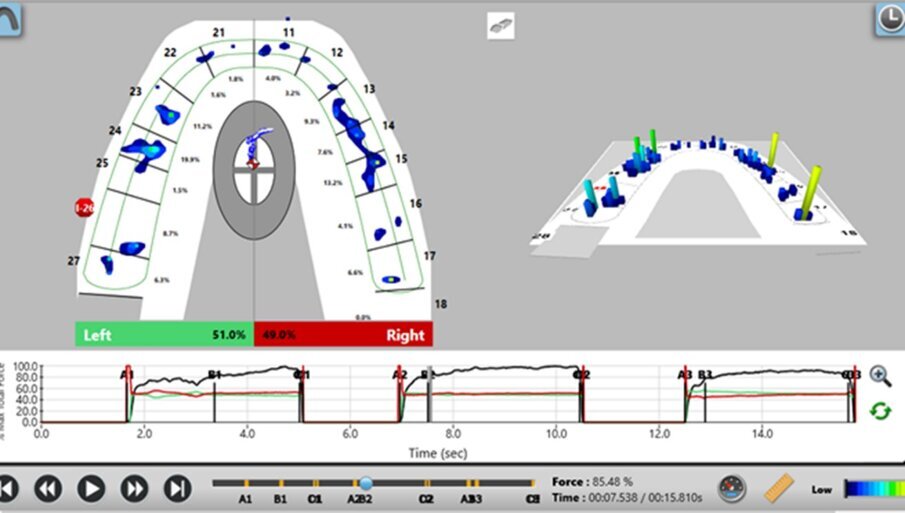 Fig 12: After occlusal adjustment, you can see the patient has equal forces, and can hold the bite smoothly(note the circled area)