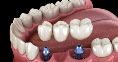 Neue S3-Leitlinie „Ersatz fehlender Zähne mit Verbundbrücken“