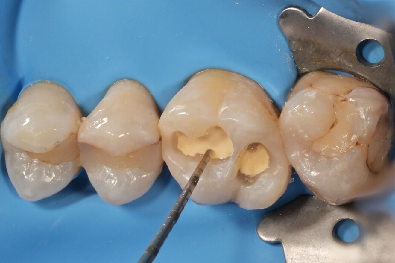 Фиг. 7: Зъбът след премахване на 1,5 мм от Biodentine.