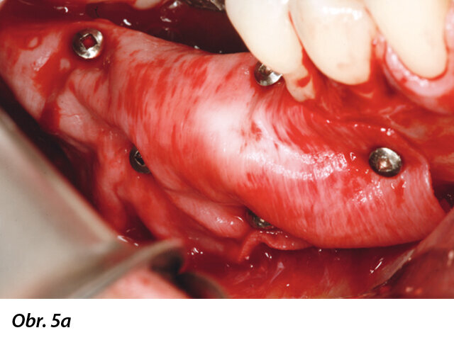 Bukální pohled na jednu membránu Geistlich Bio-Gide fixovanou titanovými piny. Piny mají průměr 1 mm a jsou v kortikální kosti dolní čelisti stabilní. Všimněte si, že fixovaná membrána zcela imobilizuje kostní štěp díky tomu, že jej „obaluje“ jako „klobásu“.