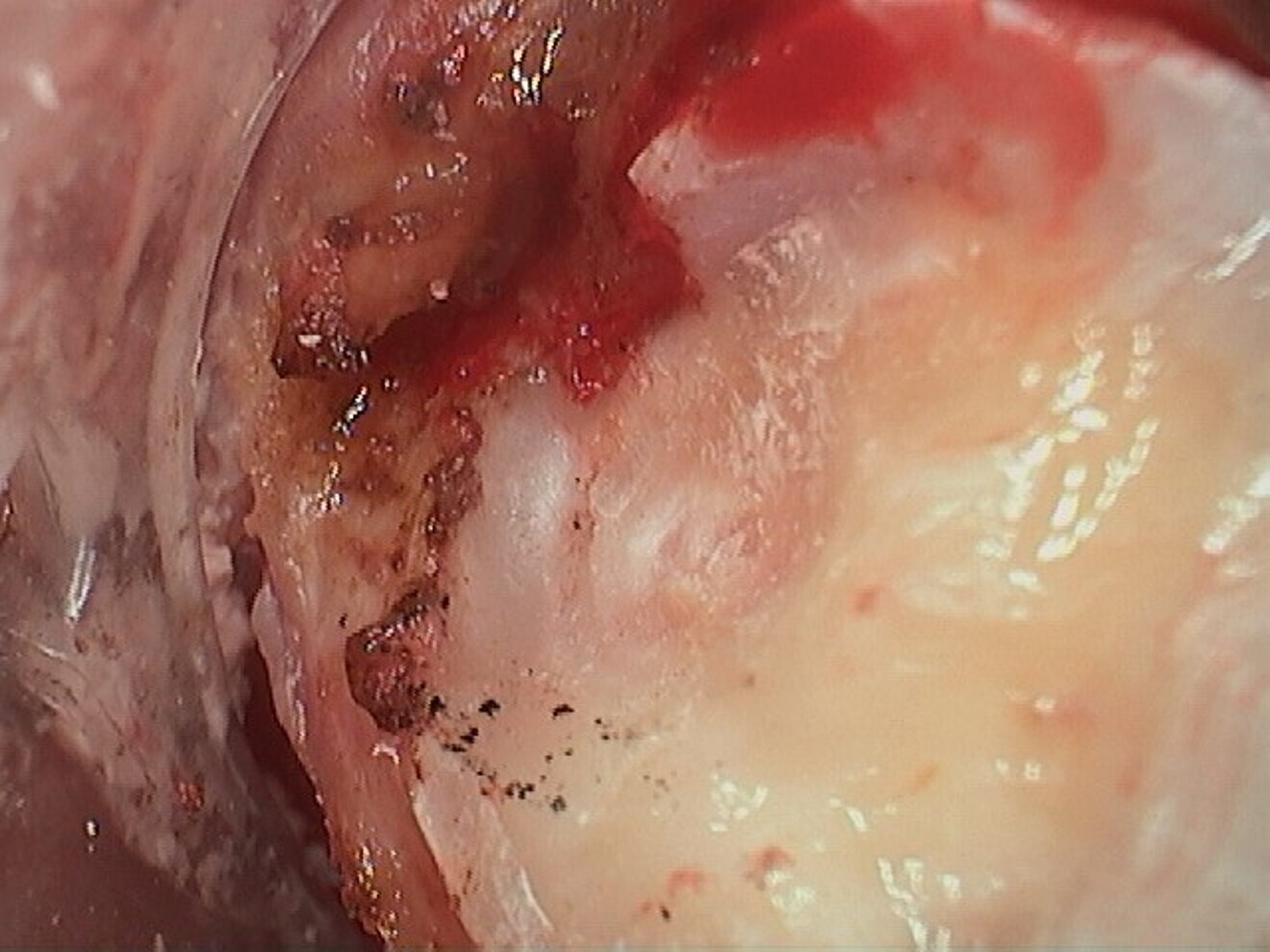 Fig. 11: Pulpal tissue seen below a thin layer of dentine after caries removal.