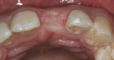 Pleidooi voor papilsparende incisies