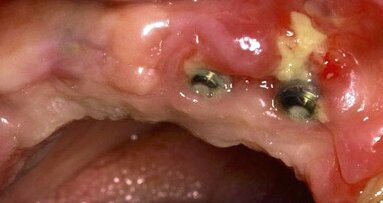 El rol del odontólogo en la osteonecrosis maxilar provocada por anticuerpos monoclonales