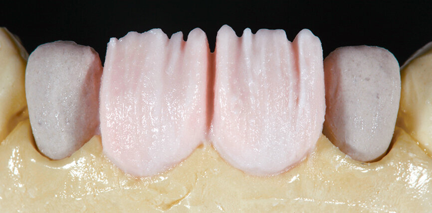 Fig. 9. El núcleo de dentina se estratificó con DENTINE A1 de manera reducida anatómicamente.