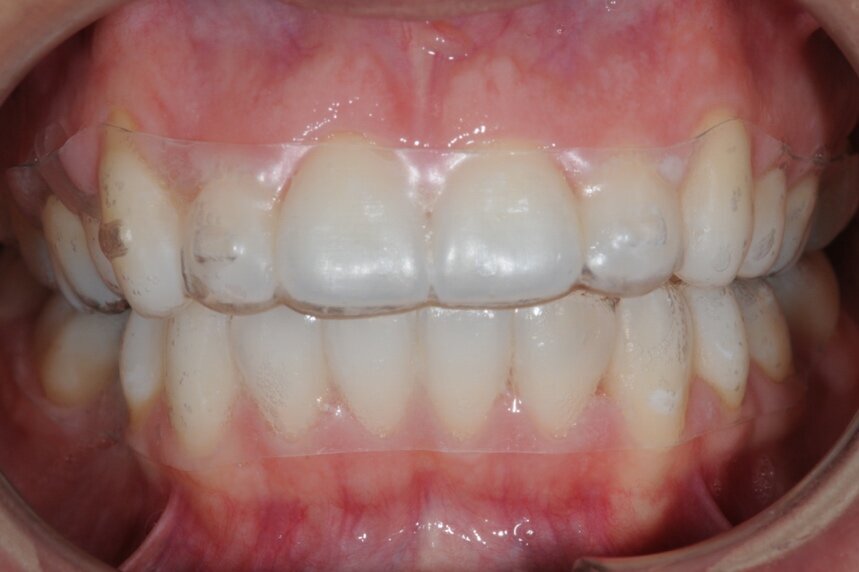 Fig. 5 - Fotografia intraorale con allineatori indossati.