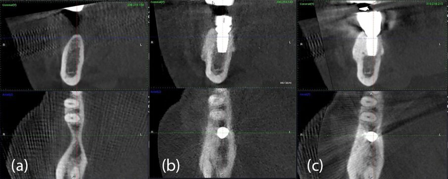 Fig. 29_Valutazione CBCT del caso 2 da sinistra a destra: a) immagini coronali e assiali preoperatorie; b) immagini coronali e assiali CBCT post-operatorie a 4 mesi; c) immagini coronali e assiali CBCT a 2 anni e 7 mesi.