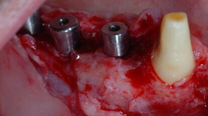 Valutazione clinica di un dispositivo riassorbibile “a cupola”, associato a GBR