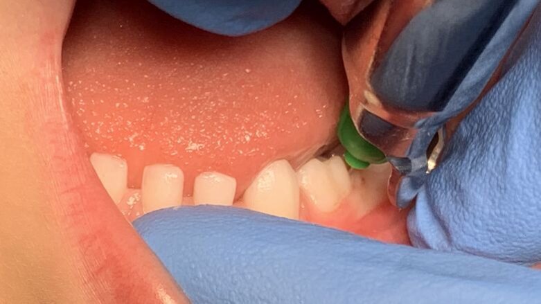 Verdovingstechnieken in de kindertandartspraktijk