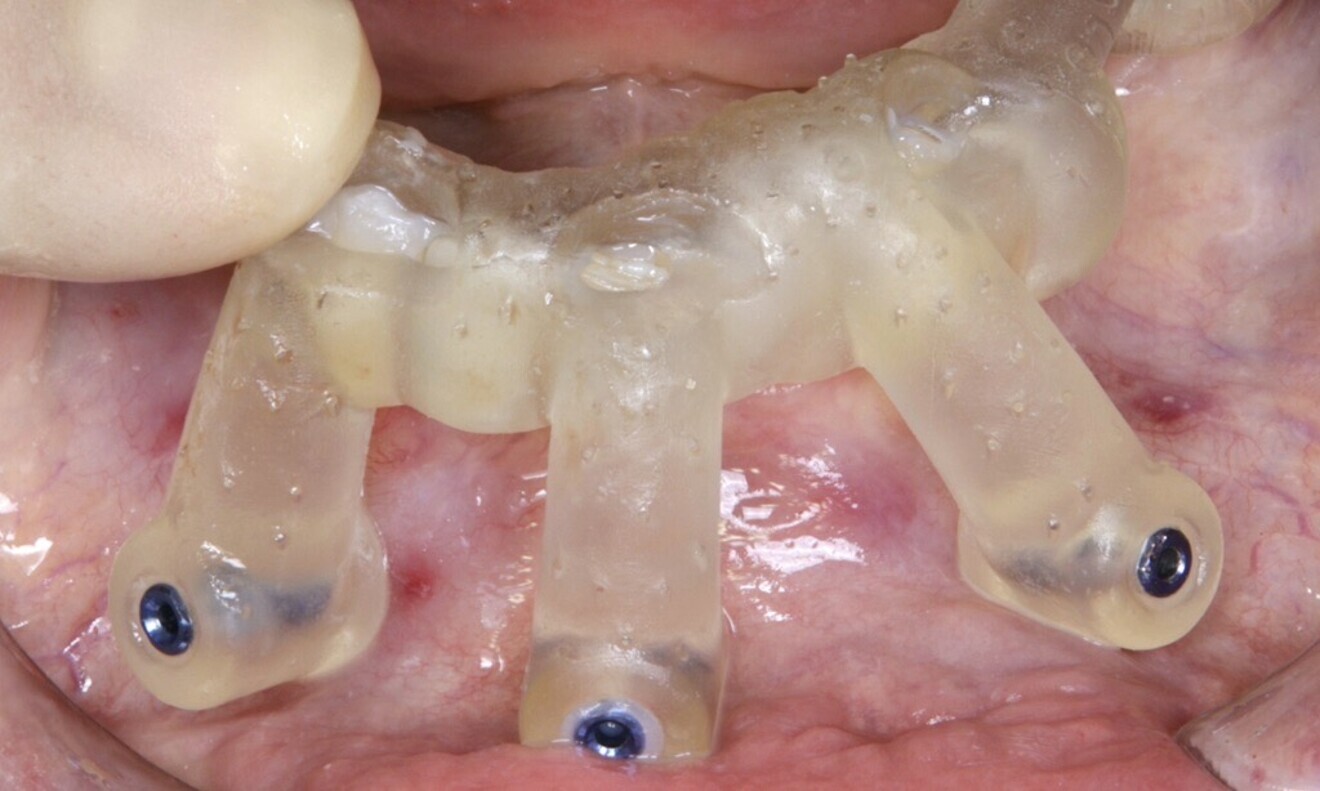 Fig. 29: The first surgical guide was checked for proper fit.