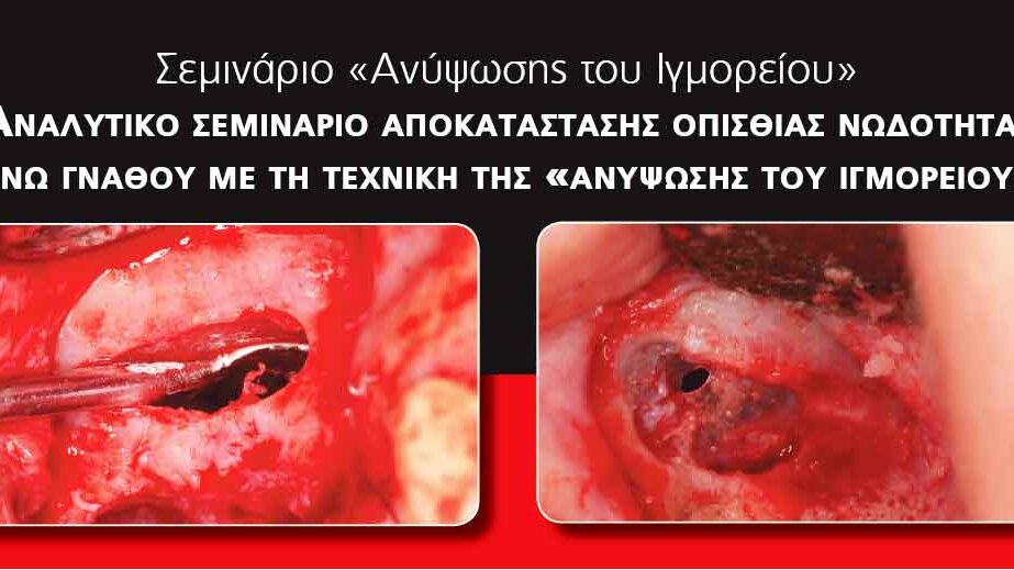 Σεμινάριο ανύψωσης του ιγμορείου