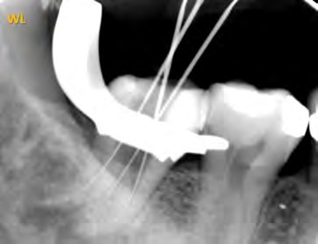  Fig. 1f: Working length radiograph confirming successful negotiation of the severely curved root canals with endodontic files.