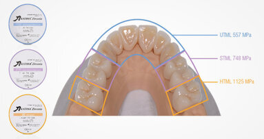 Full-mouth rehabilitation with three different types of KATANA Zirconia