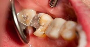 Amalgames dentaires à base de mercure : Recommandations de l’ANSM pour les professionnels de santé