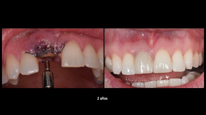Figuras 21 y 22. Imágenes del día de la intervención y a los 2 años de evolución. Se observa una regeneración casi completa del periodonto, a pesar de presentar un defecto óseo inicial muy importante en la tabla ósea cortical vestibular. Con esta técnica solucionamos en un solo acto quirúrgico, tanto la preservación como la regeneración ósea, con gran estabilidad de los resultados en el tiempo.
