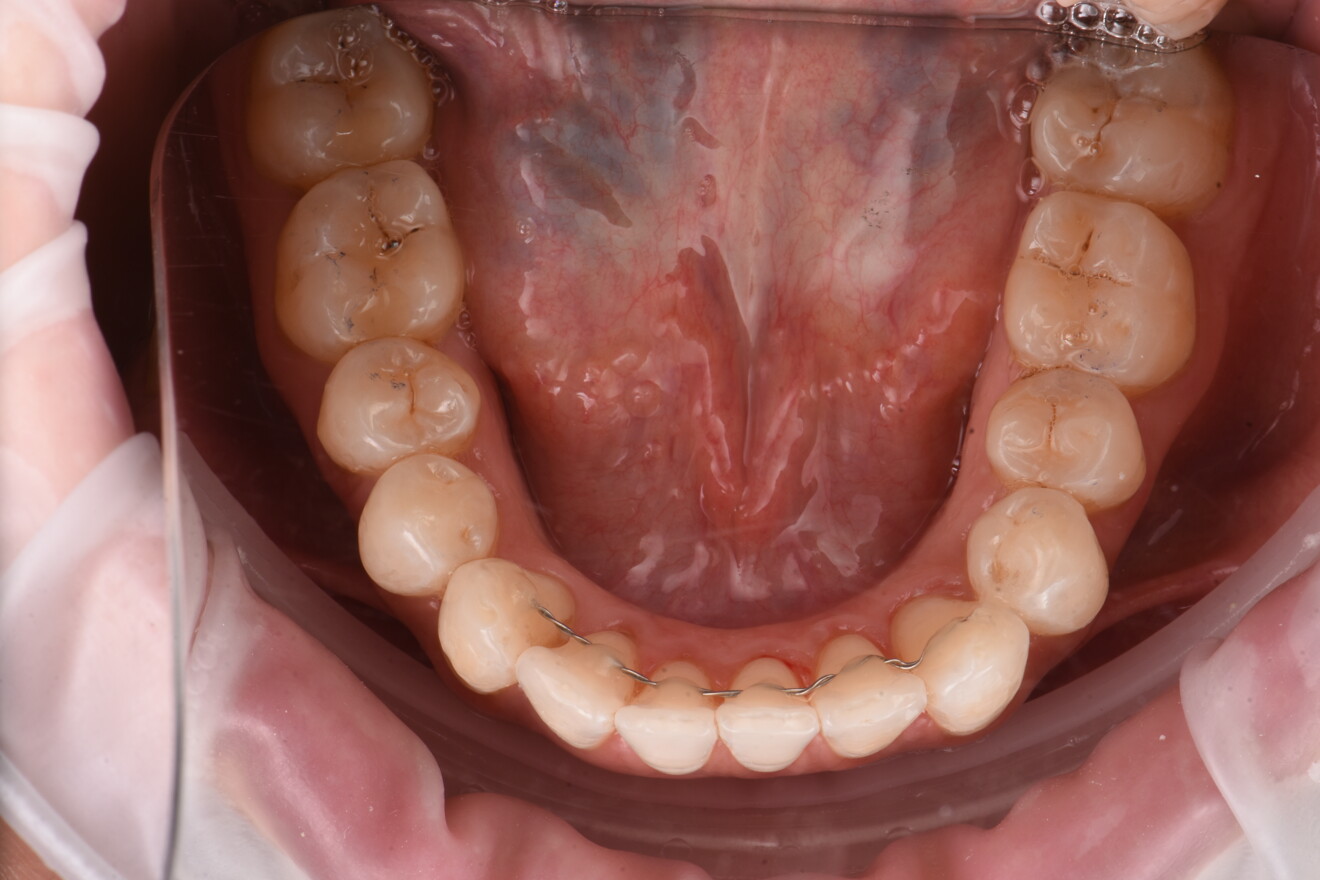 Figg. 12, 13 - Risultato finale arcata superiore e inferiore.