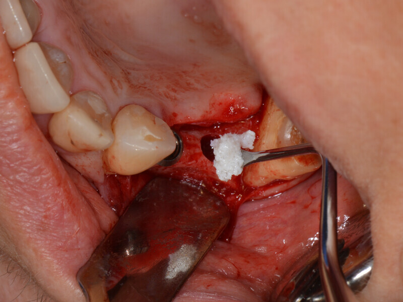 Fig. 10: Insertion of bone substitute material.