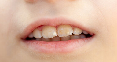 One in seven 12-year-olds in Germany suffer from MIH