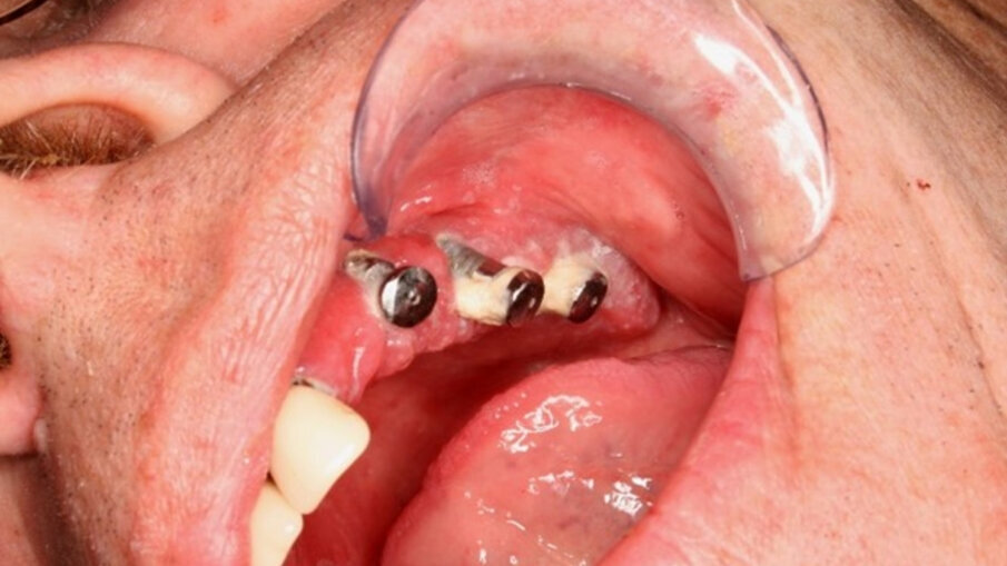 Obr. 1. Klinická periimplantitida.