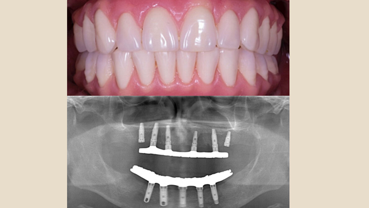 Prótesis Híbrida Inmediata en pacientes edéntulos mandibulares