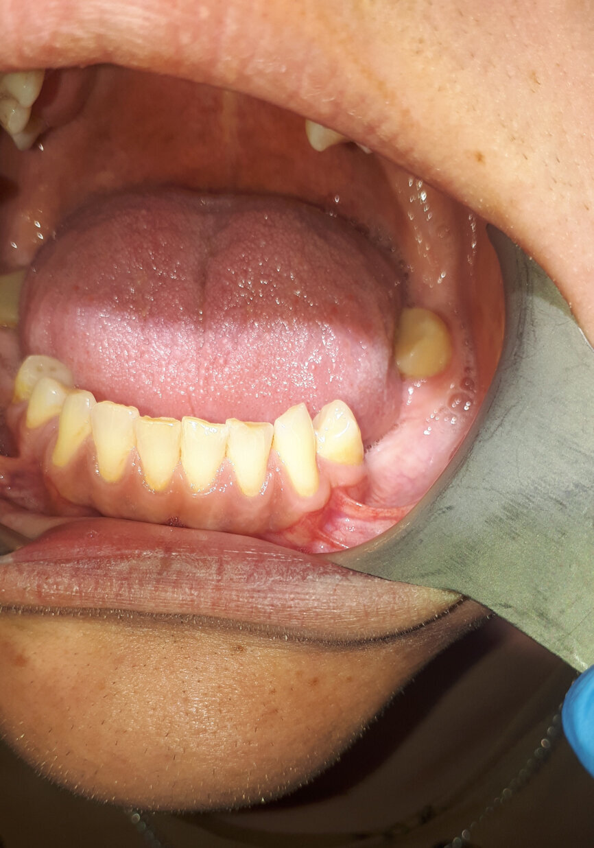 Ryc. 3: Stan 18 miesięcy po zabiegu.