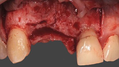 L’aumento del tessuto osseo nei settori estetici con utilizzo di griglie customizzate e Geistlich Mucograft