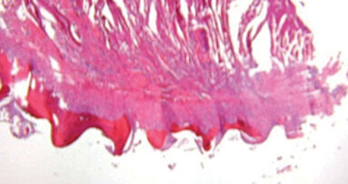 Why you’re missing out if you’re avoiding the use of mini-implants