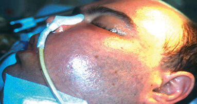 Le infezioni post-operatorie nella chirurgia odontoiatrica