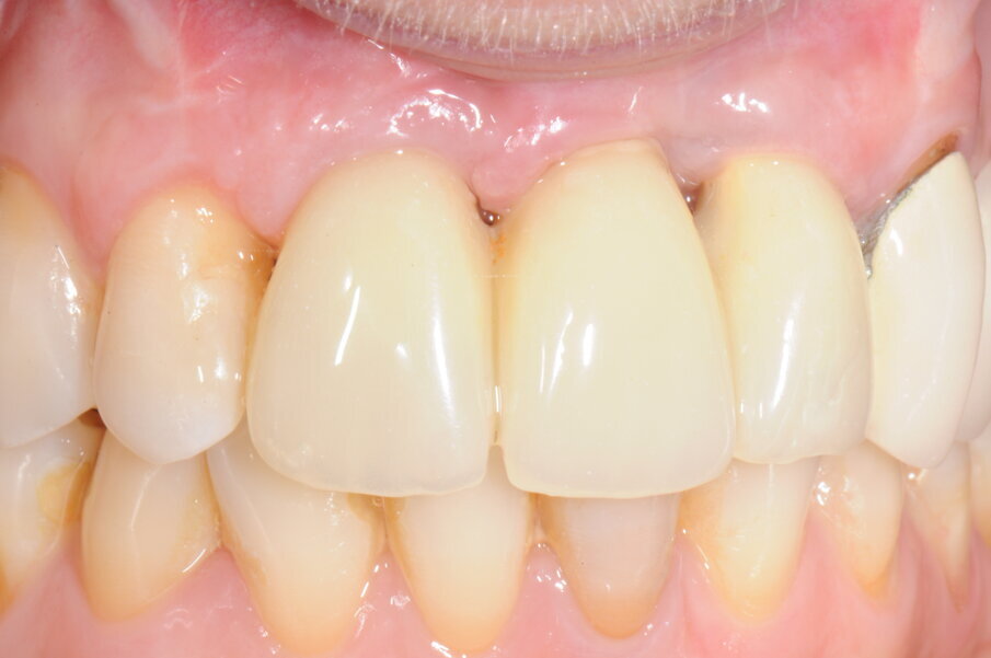 Figg. 24a, 24b - Protesi provvisoria in visione occlusale e frontale.