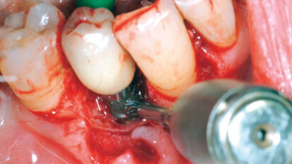 Mario Roccuzzo: quando e come trattare le complicanze perimplantari