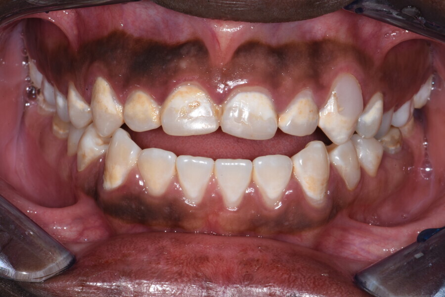 Figs. 2a & b: Open bite and Class III incisor relationship due to atypical swallowing and lower tongue position at rest.