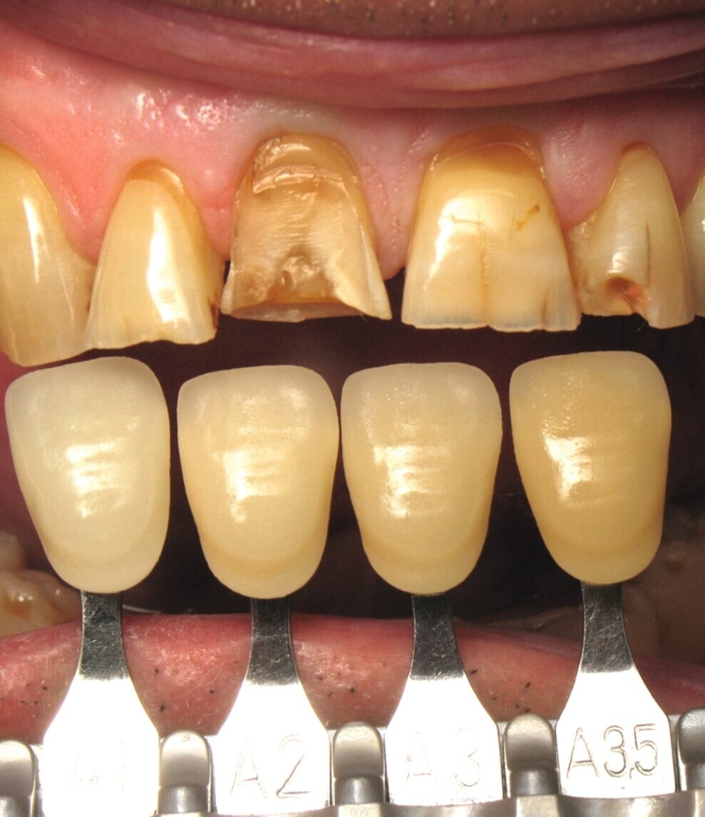Fig. 10 : Teinte dentaire préopératoire.