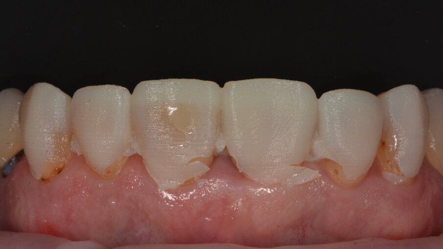 De mock-up in de mond werd gebruikt om minimaal invasief buccaal een kleine chamfer te verkrijgen om de verkleurde elementen te kunnen maskeren.
