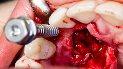 Nano-coating effective in reducing peri-implantitis risk