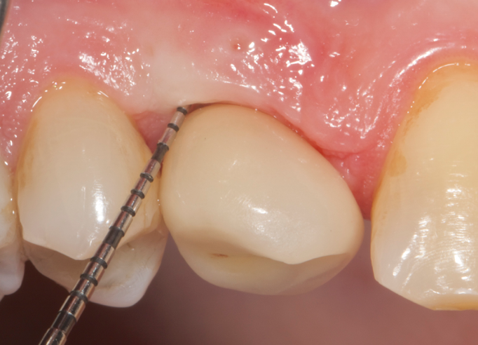 Fig.10: Case 1. Healing at 6 months after MAINST therapy. PPD has decreased to 2mm. BOP and suppuration are absent.