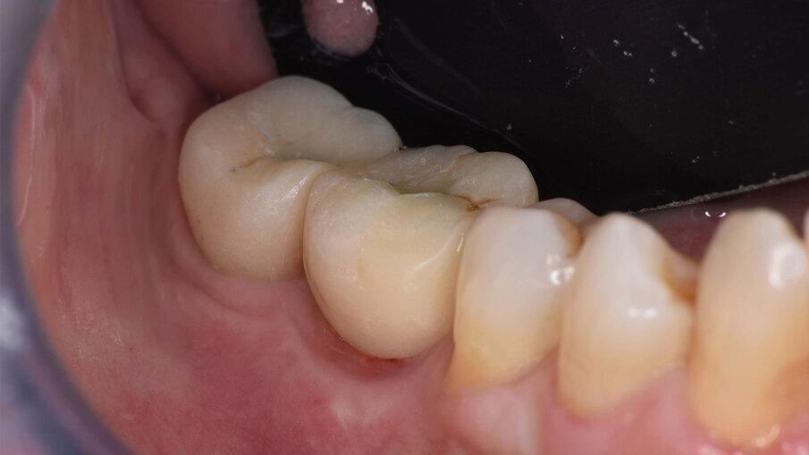 Figg. 12a, 12b_Immagine clinica e radiografica che mostrano il manufatto protesico provvisorio.