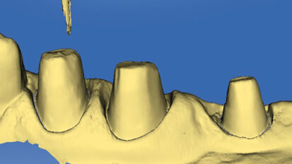 Il flusso digitale nella realizzazione di corone CAD/CAM in disilicato di litio su denti naturali preparati senza linea di finitura