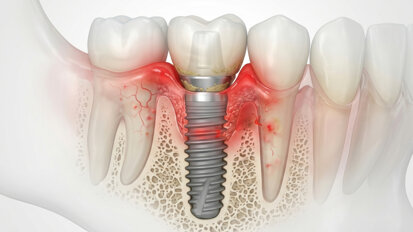 Diabetes associated with poorer long-term dental implant outcomes