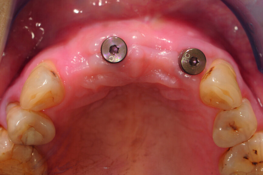 Fig. 8: Occlusal view of the anterior teeth three months post-op.