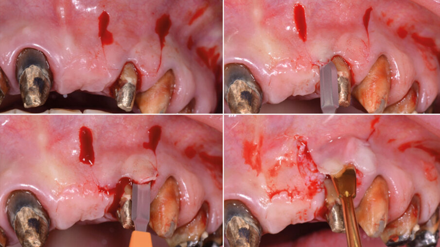 Fig. 5 - Lembo e scollamento con inserto piezo.