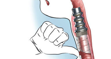 Eerste artificiële strottenhoofd geplaatst