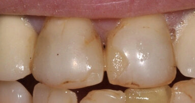 ¿Qué ha cambiado en el fotocurado?