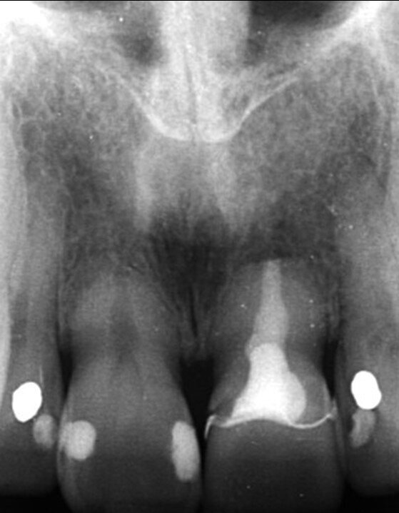 Fig. 3_Radiografia periapicale pre-operatoria.